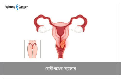 Vaginal Cancer