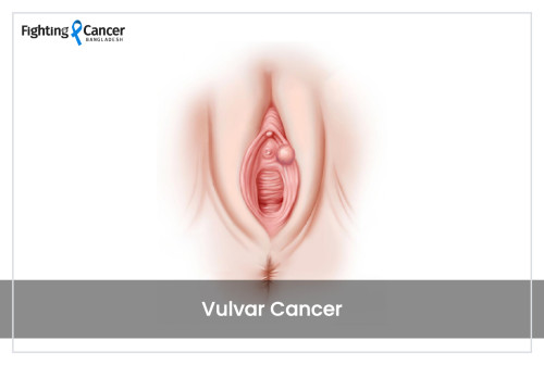 Vulvar Cancer