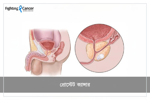 প্রোস্টেট ক্যান্সার