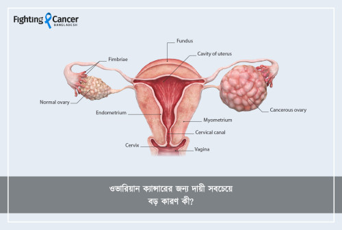 ওভারিয়ান ক্যান্সারের জন্য দায়ী সবচেয়ে বড় কারণ কী?