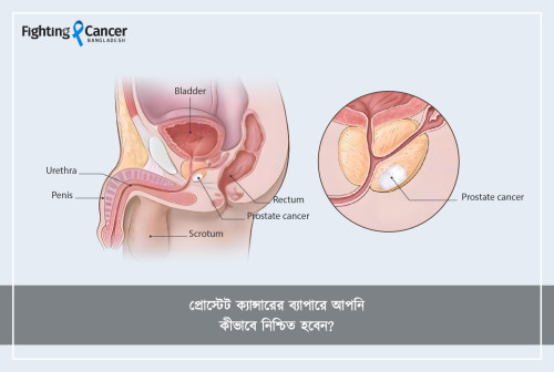 প্রোস্টেট ক্যান্সারের ব্যাপারে আপনি কীভাবে নিশ্চিত হবেন?