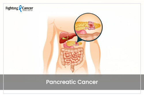 Pancreatic Cancer